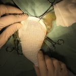 Chirurgie d'une rupture de ligament croisé