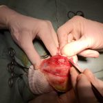 Chirurgie d'une rupture de ligament croisé